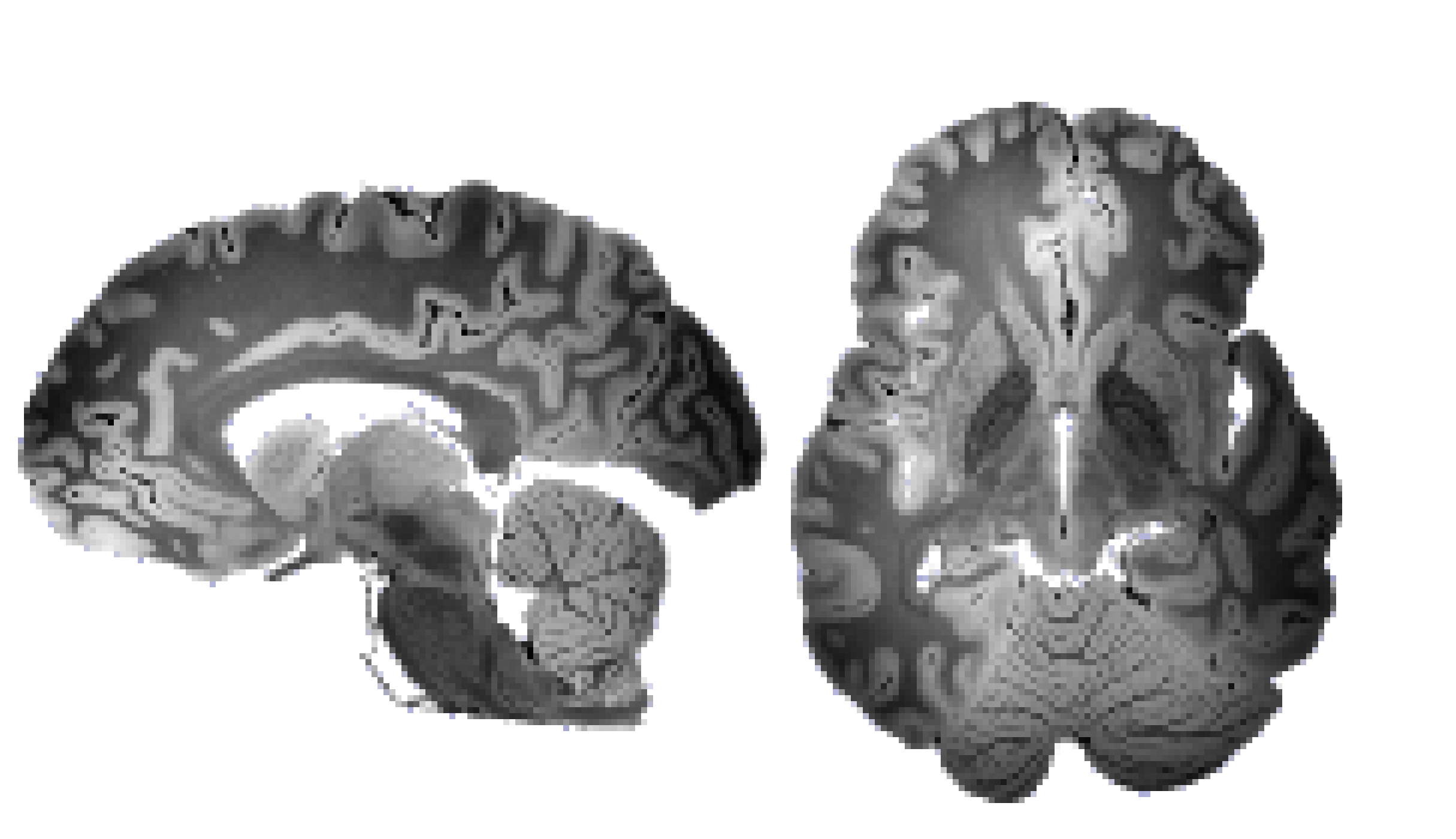 [ec64cb] MRI Brain Scan